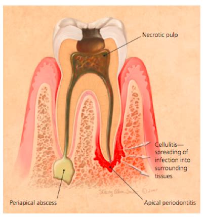 Jenis Penambalan Gigi Yang Cocok Setelah Perawatan Saluran Akar - Tanya ...