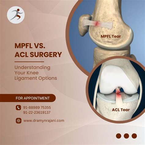 MPFL vs. ACL Surgery - Understanding Your Knee Ligament Options