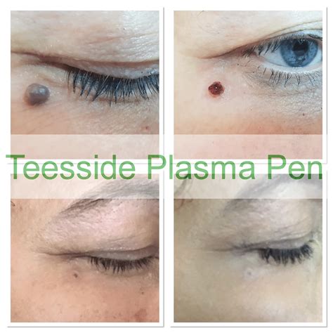 Cherry Angioma Removal Oxford at Emma Ake blog