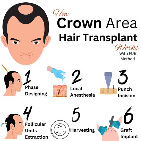 Crown Hair Transplant in Turkey - Imperium Hair Transplant Clinic - Turkey