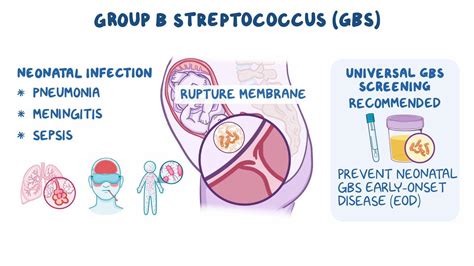 Group B streptococcus (GBS) colonization in pregnancy: Video & Meaning | Osmosis