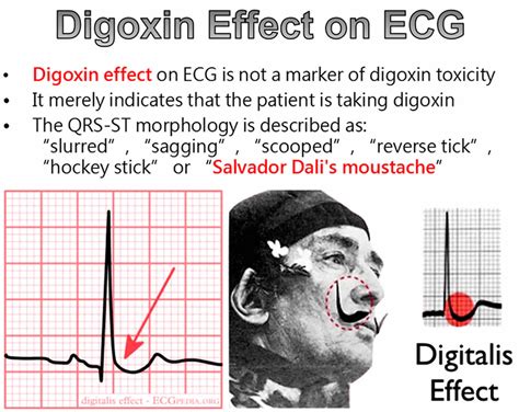 Digoxin toxicity signs & symptoms, causes, ECG, diagnosis and treatment