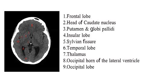Image result for Normal Brain CT Scan