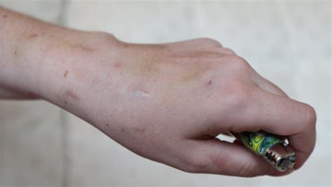 Heroin Track Marks On Hands