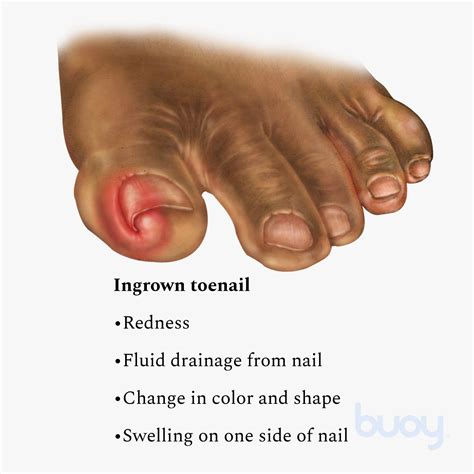 ingrown toenail with infection Fungal toenails and onychomycosis
