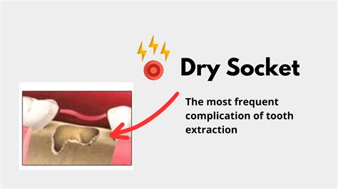 Image result for Tooth Extraction Dry Socket