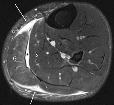 Imaging Evaluation for Calf Pain | RadioGraphics