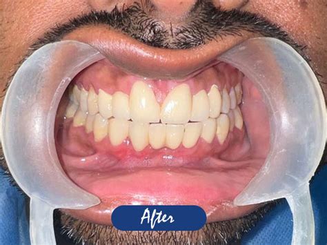 General Dentistry in Kolkata | Teeth Bleaching