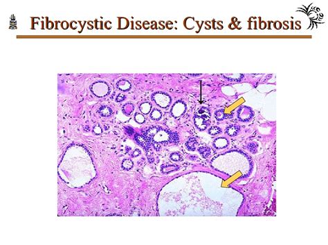 PPT - Pathology of Breast Disorders PowerPoint Presentation, free download - ID:8201844