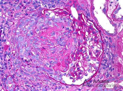 Endocarditis-Associated Glomerulonephritis | Teaching Points