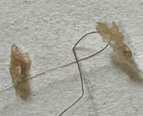 Scalp Parasites 的图像结果