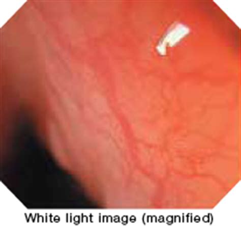 NBI | Olympus Innovations | Olympus Medical Systems India