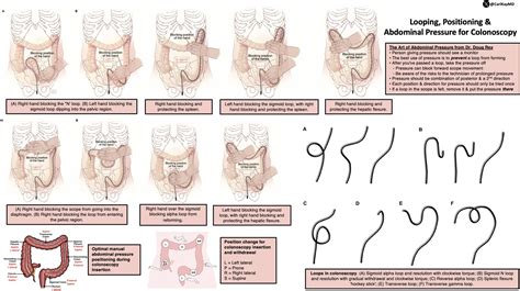 Image result for Colonoscopy Positioning