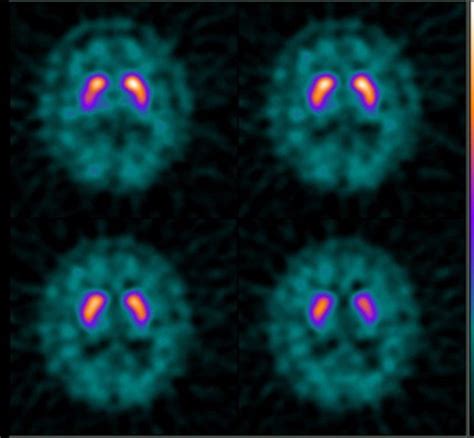 Image result for Dat Scan Utube