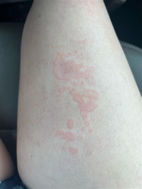 What is this on my thigh? It’s not really that itchy but like swollen ...