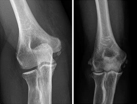 Accessory Ossicles Elbow Radiology at Harold Case blog