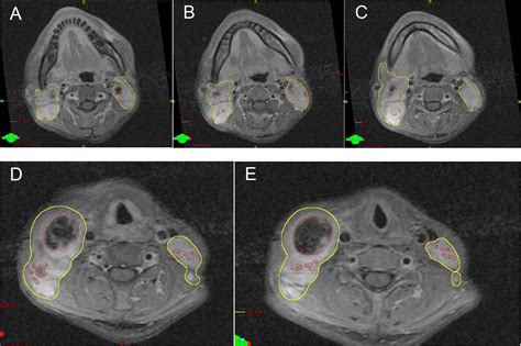 Prognostic value of the cervical lymph node necrosis ratio in ...
