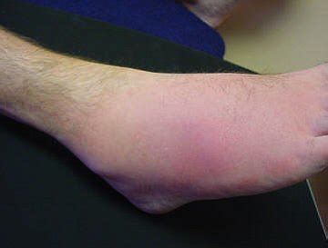 Gout in the Ankle | The Gout Killer - Bert Middleton