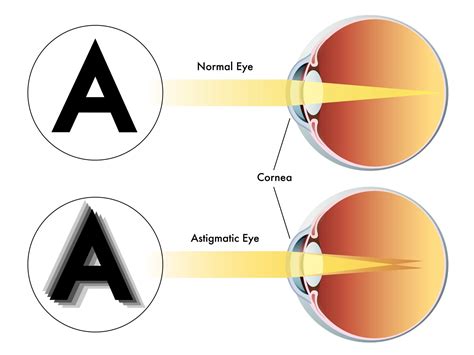 What is Astigmatism? Symptoms, Causes & Correction Options