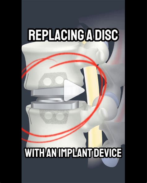 Image result for Disc Replacement Procedure