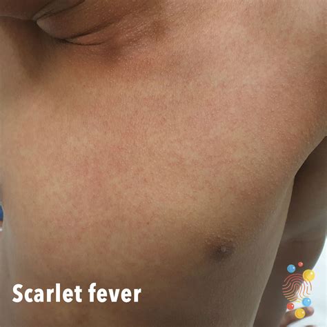 Sandpaper Rash Scarlet Fever at Stanley Barnes blog
