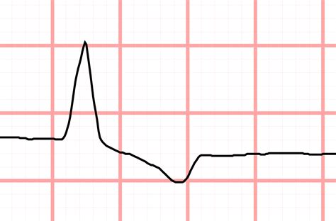 J point ECG
