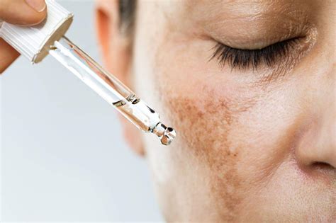 Understanding Melasma from a Holistic Approach: Triggers & Treatments ...