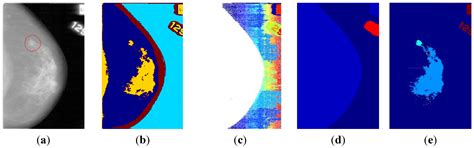 Mammographic Segmentation Using WaveCluster