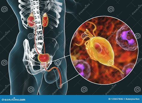 Trichomoniasis Infection in Man Stock Illustration - Illustration of ...