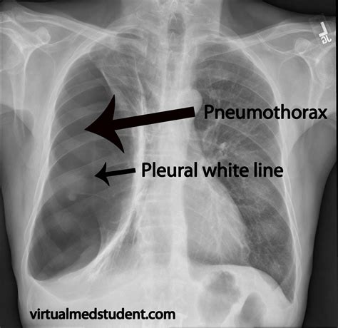 How To Identify Pneumothorax On Chest X Ray at James Urbina blog