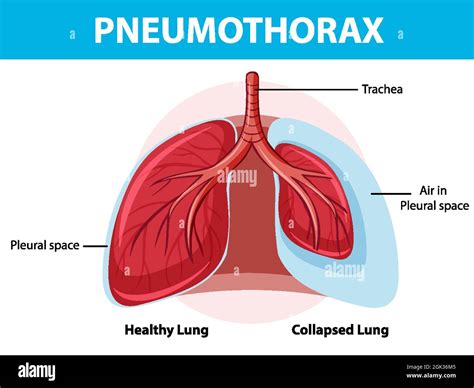 Pneumothorax diagram with collapsed lung and healthy lung illustration Stock Vector Image & Art ...