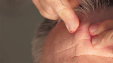 Image result for Blood Red Pimple