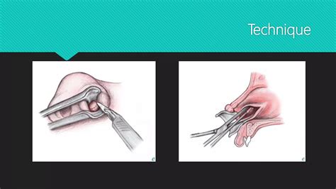 Nasal Septal Hematoma Drainage | PPTX