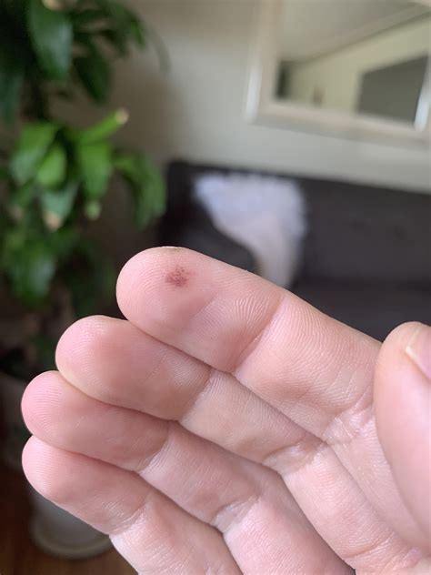 Kuvatulokset haulle blood blister