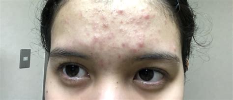 Mild Cystic Acne Forehead