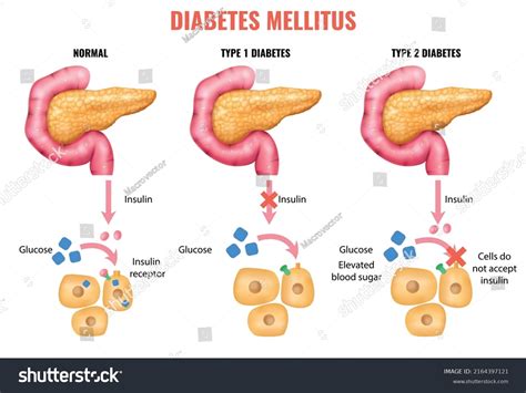 Pancreatin And Diabetes