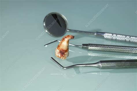 Extracted Wisdom Tooth 的图像结果