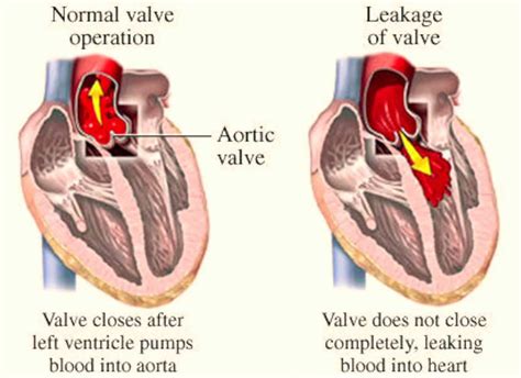 Mild Leaky Heart Valve