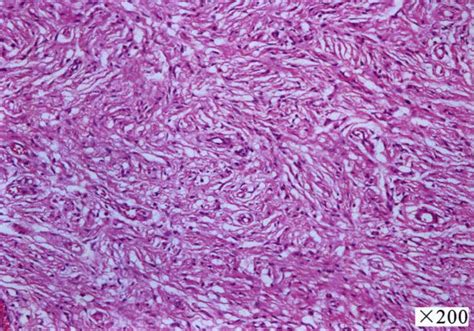 NEJM：2型神经纤维瘤病中的双侧前庭神经鞘瘤-病例报道-MedSci.cn