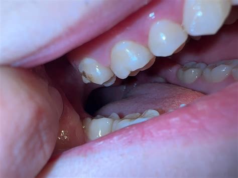 What are these brown spots on my molars and how bad are they? : r/askdentists