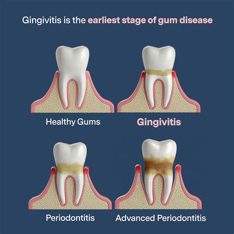 A Comprehensive Guide to Gingivitis