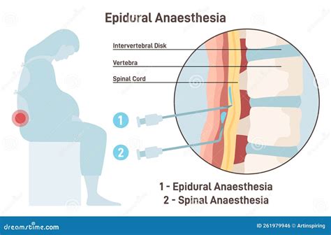 Spinal Block Vs Epidural