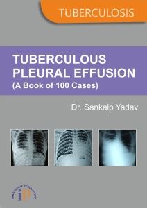 Tuberculous Pleural Effusion (A Book of 100 Cases): Buy Tuberculous ...