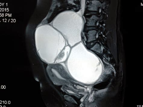 VIETNAMESE MEDIC ULTRASOUND: CASE 302 : OVARY TUMOR , Dr PHAN THANH HẢI, MEDIC MEDICAL CENTER ...