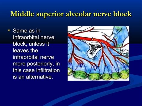 Maxillary Local Anesthesia 的图像结果