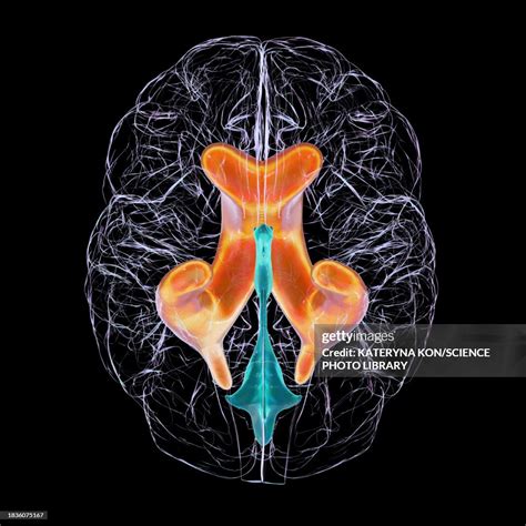 Enlarged Lateral Ventricles Of The Brain Illustration High-Res Vector Graphic - Getty Images