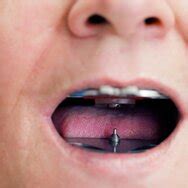 Conventional Removable Prosthetics by Ivoclar : Ivoclar