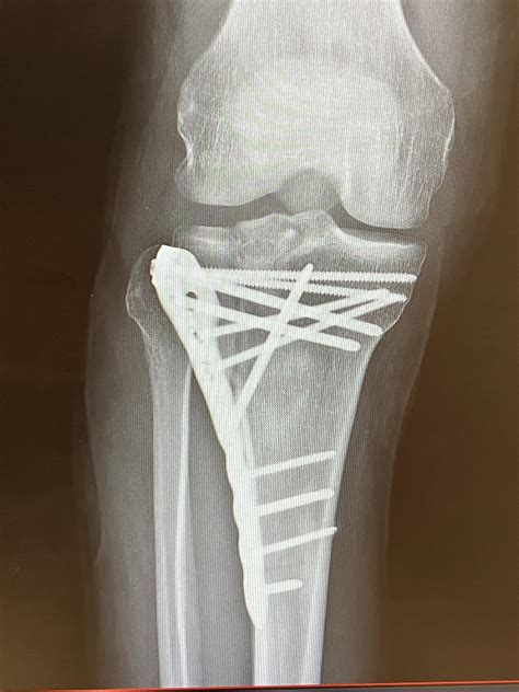 Broken Tibial Plateau