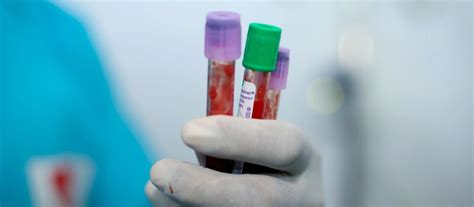 Aplastic Anemia (Pediatric Hemato Oncology) | Ailments - MGMCH, Jaipur