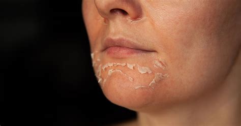 Put Your Best Face Forward: Peeling Away the Impurities – Caresupp.in